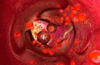 عوامل تومورزایی سرطان پانکراس در مردان شناسایی شد