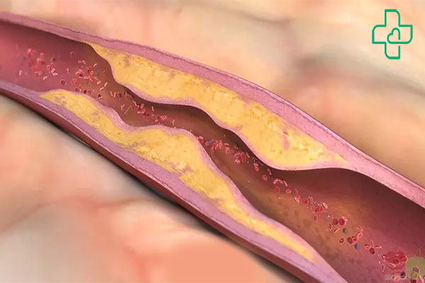رابطه مستقیم آترواسکلروز عروقی با سکته قلبی و مغزی در سالمندان