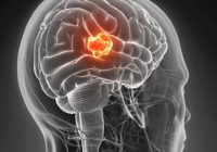 واکسن MRNA با تومور مرگبار مغز مبارزه می کند