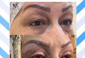 بلفاروپلاستی بدون رد بخیه با دکتر خشایار سنجری