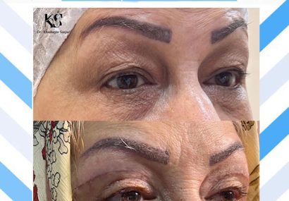 بلفاروپلاستی بدون رد بخیه با دکتر خشایار سنجری