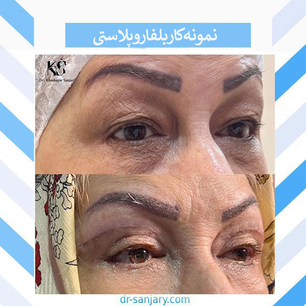 بلفاروپلاستی بدون رد بخیه با دکتر خشایار سنجری
