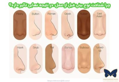 چرا شناخت نوع بینی قبل از عمل، در نتیجه نهایی تاثیر دارد؟