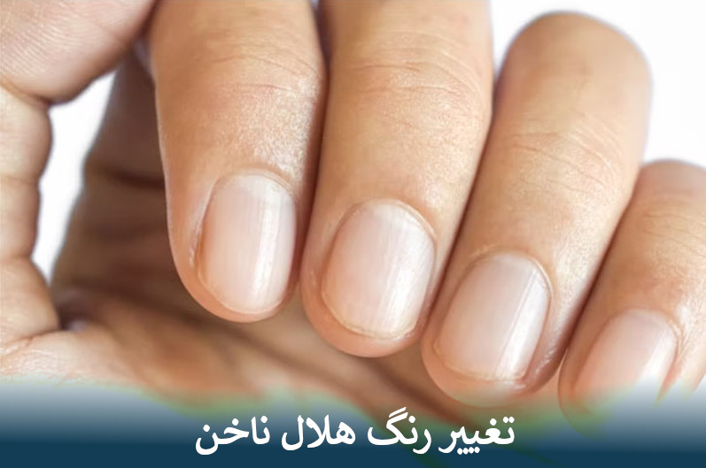 تغییر رنگ هلال ناخن